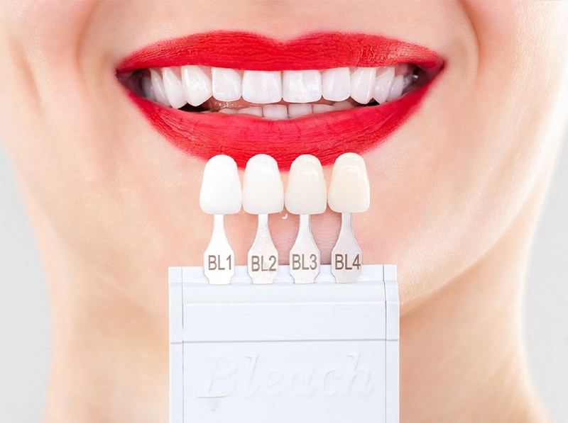 porcelain-veneers-3